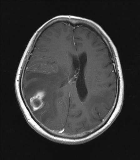 頭部MRI（造影T1強調画像）